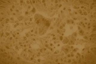 Canada Loses Measles Elimination Status After 5,000 Cases Across Nine Provinces