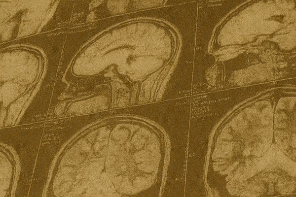 New Brunswick Delays Report on Mysterious Brain Disease Investigation